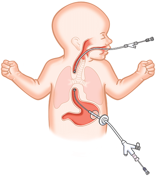 Pancreatic Disorders in Children
