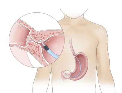 Pancreatic Disorders in Children
