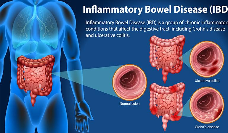 Pancreatic Disorders in Children
