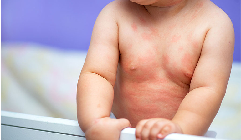 Pancreatic Disorders in Children